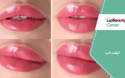 لیفت لب: انواع روش‌های جراحی و غیر جراحی