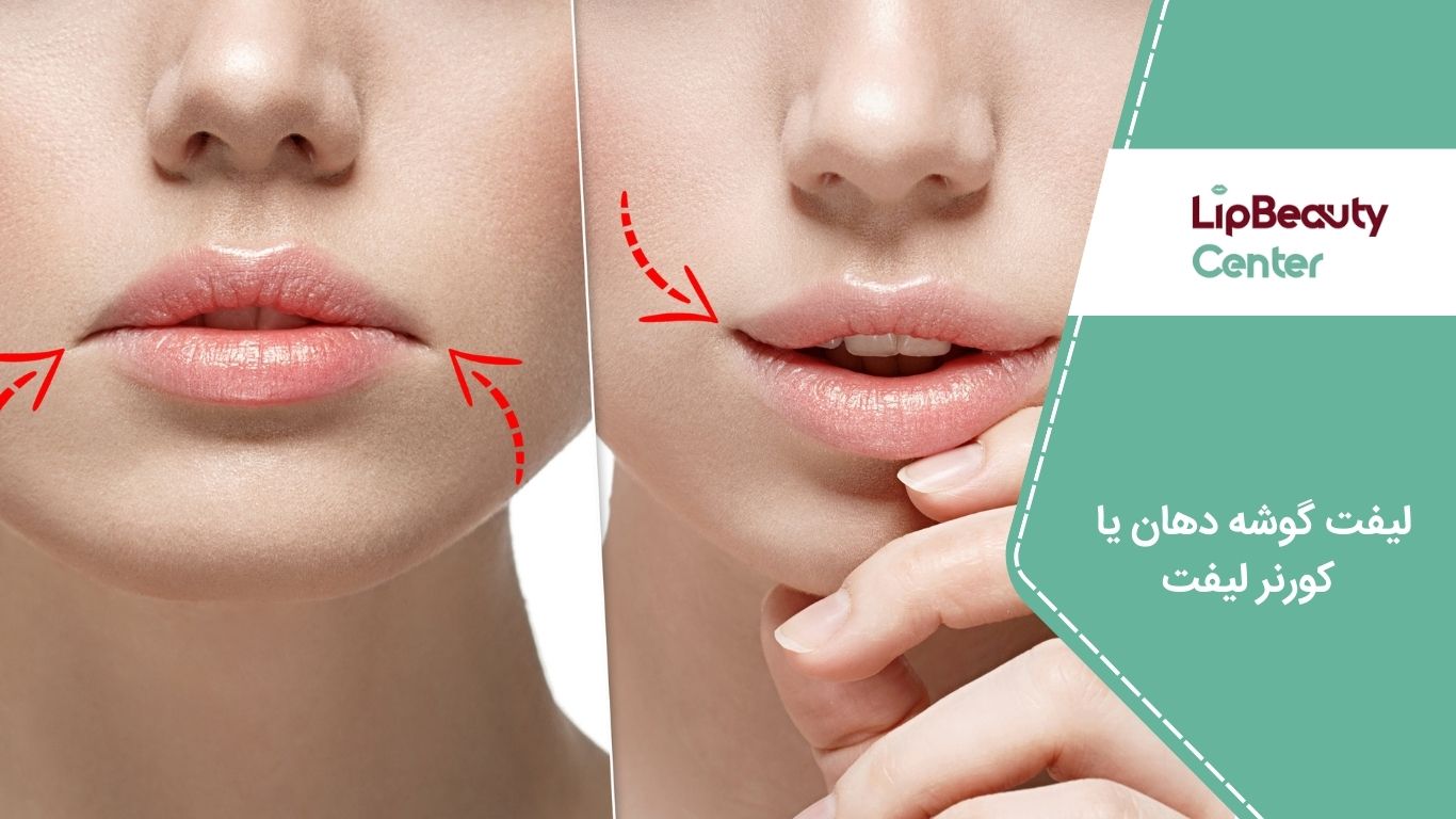 لیفت گوشه دهان یا کورنر لیفت لب