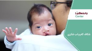 شکاف کام و لب شکری